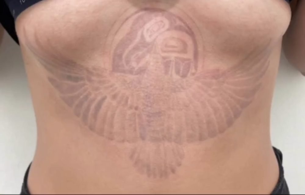 Same chest tattoo faded to a faint outline after three sessions
