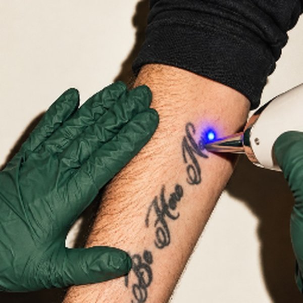 Laser treatment on a script forearm tattoo
