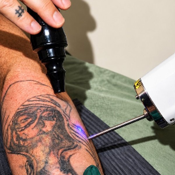 Laser treatment on a large forearm tattoo