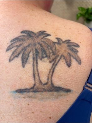 Same palm tree tattoo visibly lighter after one session