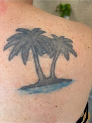Palm tree tattoo on shoulder blade before treatment